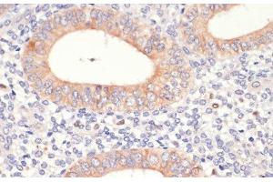 Immunohistochemistry of paraffin-embedded Human uterine cancer using HMGCR Polyclonal Antibody at dilution of 1:200 (40x lens). (HMGCR Antikörper)