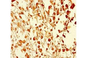 Immunohistochemistry of paraffin-embedded human melanoma using ABIN7174595 at dilution of 1:100 (UBXN2B Antikörper  (AA 2-250))