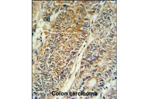 PYCR1 Antibody IHC analysis in formalin fixed and paraffin embedded colon carcinoma followed by peroxidase conjugation of the secondary antibody and DAB staining. (PYCR1 Antikörper  (C-Term))
