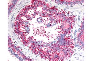 Anti-V1RL1 / VN1R1 antibody IHC of human Breast, Carcinoma. (VN1R1 Antikörper  (C-Term))