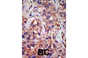 Formalin-fixed and paraffin-embedded human cancer tissue reacted with the primary antibody, which was peroxidase-conjugated to the secondary antibody, followed by DAB staining. (USP8 Antikörper  (C-Term))