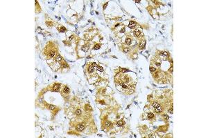 Immunohistochemistry of paraffin-embedded human liver cancer using RRAGD antibody (ABIN6132084, ABIN6147254, ABIN6147255 and ABIN6225325) at dilution of 1:100 (40x lens). (RRAGD Antikörper  (AA 181-400))