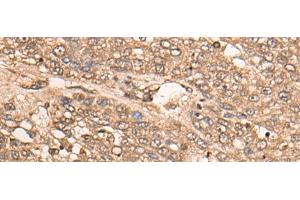 Immunohistochemistry of paraffin-embedded Human liver cancer tissue using B4GALNT2 Polyclonal Antibody at dilution of 1:35(x200)