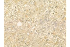 ABIN6264322 and ABIN6277635 at 1/100 staining human astrocytoma by IHC-P. (PNMT Antikörper  (N-Term))