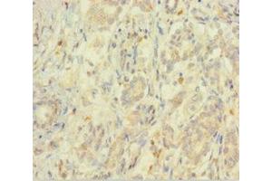 Immunohistochemistry of paraffin-embedded human pancreatic cancer using ABIN7152209 at dilution of 1:100 (EIF5 Antikörper  (AA 1-431))