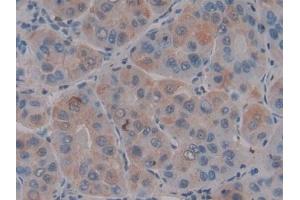 Detection of SDF1 in Human Liver cancer Tissue using Polyclonal Antibody to Stromal Cell Derived Factor 1 (SDF1)