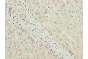 Immunohistochemistry of paraffin-embedded human liver cancer using ABIN7158480 at dilution of 1:100 (Uncharacterized Protein C7orf34 (LLCFC1) (AA 29-122) Antikörper)