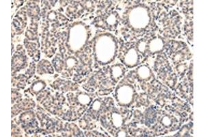 The image on the left is immunohistochemistry of paraffin-embedded Human thyroid cancer tissue using ABIN7131585(VPS37D Antibody) at dilution 1/30, on the right is treated with fusion protein. (VPS37D Antikörper)