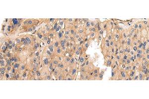 Immunohistochemistry of paraffin-embedded Human liver cancer using VAMP5 Polyclonal Antibody at dilution of 1/25