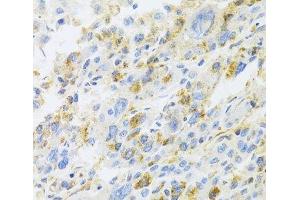 Immunohistochemistry of paraffin-embedded Human liver cancer using CXCR3 Polyclonal Antibody at dilution of 1:100 (40x lens).