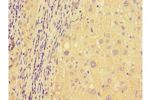 Immunohistochemistry of paraffin-embedded human liver cancer using ABIN7150136 at dilution of 1:100 (DDIT4L Antikörper  (AA 1-163))