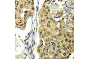 Immunohistochemistry of paraffin-embedded human lung cancer using DDX1 antibody at dilution of 1:100 (x40 lens). (DDX1 Antikörper)