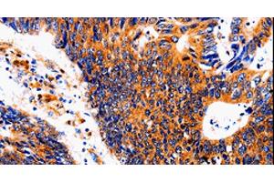Immunohistochemistry of paraffin-embedded Human colon cancer tissue using IL18BP Polyclonal Antibody at dilution 1:50 (IL18BP Antikörper)