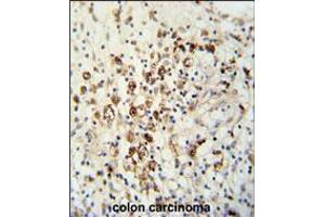 HAUS5 Antibody immunohistochemistry analysis in formalin fixed and paraffin embedded human colon carcinoma followed by peroxidase conjugation of the secondary antibody and DAB staining. (HAUS5 Antikörper  (N-Term))