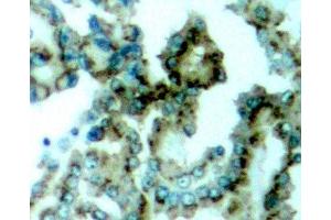 Immunohistochemistry of paraffin-embedded Human lung carcinoma tissue, using Phospho-PKCalpha/beta II(T638/641) Polyclonal Antibody (PRKCA beta 2 Antikörper  (pThr638, pThr641))