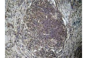 Immunohistochemical staining of human breast cancer tissue with HIST1H3D (Di-methyl-K27) polyclonal antibody  under 1:50-1:100 dilution.
