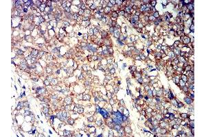 Immunohistochemical analysis of paraffin-embedded breast cancer tissues using ATG3 mouse mAb with DAB staining.
