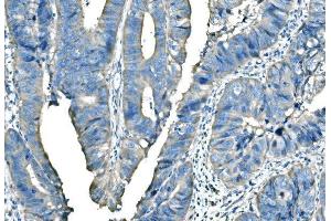 IHC analysis of B Raf/BRAF using anti-B Raf/BRAF antibody (ABIN3043761). (BRAF Antikörper  (AA 38-230))