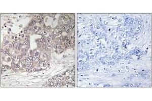 Immunohistochemistry analysis of paraffin-embedded human liver carcinoma tissue, using ATG4C Antibody. (ATG4C Antikörper  (AA 21-70))