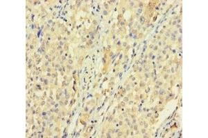 Immunohistochemistry of paraffin-embedded human lung cancer using ABIN7170528 at dilution of 1:100 (SPATS1 Antikörper  (AA 1-300))