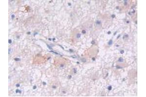 IHC-P analysis of Human Glioma Tissue, with DAB staining. (EGFR Antikörper  (AA 713-984))