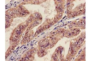 Immunohistochemistry of paraffin-embedded human endometrial cancer using ABIN7142023 at dilution of 1:100 (AGPAT5 Antikörper  (AA 174-313))