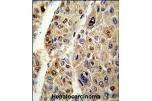 Formalin-fixed and paraffin-embedded human hepatocarcinoma reacted with SERPINC1 Antibody , which was peroxidase-conjugated to the secondary antibody, followed by DAB staining. (SERPINC1 Antikörper  (C-Term))