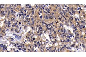 Detection of MIP3b in Human Lymphoma Tissue using Polyclonal Antibody to Macrophage Inflammatory Protein 3 Beta (MIP3b) (CCL19 Antikörper  (AA 22-98))