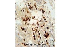 WDR21C antibody (N-term) immunohistochemistry analysis in formalin fixed and paraffin embedded human colon carcinoma followed by peroxidase conjugation of the secondary antibody and DAB staining. (DCAF4L2 Antikörper  (N-Term))