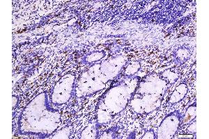 Formalin-fixed and paraffin embedded human colon cancer tissue labeled with Anti-Beta-Catenin (Ser33 + 37) Polyclonal Antibody, Unconjugated  at 1:200 followed by conjugation to the secondary antibody and DAB staining. (beta Catenin Antikörper  (pSer33, pSer37))