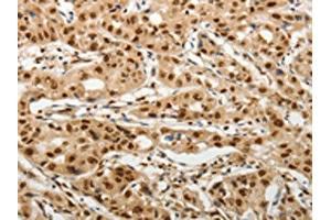 The image on the left is immunohistochemistry of paraffin-embedded Human lung cancer tissue using ABIN7192598(SOCS7 Antibody) at dilution 1/30, on the right is treated with synthetic peptide. (SOCS7 Antikörper)
