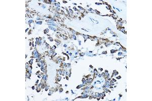 Immunohistochemistry of paraffin-embedded human thyroid cancer using O Rabbit pAb (ABIN6133230, ABIN6137338, ABIN6137339 and ABIN6224128) at dilution of 1:100 (40x lens). (ATP5O Antikörper  (AA 24-213))