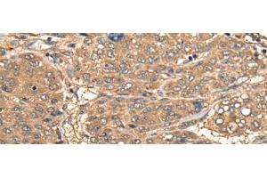 Immunohistochemistry of paraffin-embedded Human liver cancer tissue using CCL27 Polyclonal Antibody at dilution of 1:55(x200) (CCL27 Antikörper)