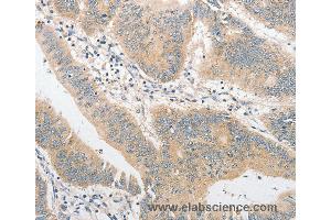 Immunohistochemistry of Human colon cancer using TLR4 Polyclonal Antibody at dilution of 1:40 (TLR4 Antikörper)