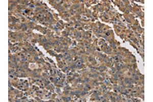 The image on the left is immunohistochemistry of paraffin-embedded Human liver cancer tissue using ABIN7191171(KCNG1 Antibody) at dilution 1/40, on the right is treated with synthetic peptide. (KCNG1 Antikörper)