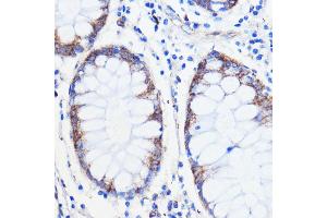 Immunohistochemistry of paraffin-embedded human colon carcinoma using TMED3 antibody (ABIN7270944) at dilution of 1:100 (40x lens). (TMED3 Antikörper  (AA 24-180))