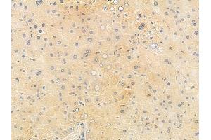 ABIN6265357 and ABIN6278222 at 1/100 staining human hepatocellular carcinoma by IHC-P. (STXBP1 Antikörper  (C-Term))