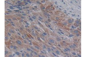 DAB staining on IHC-P; Samples: Human Lung cancer Tissue