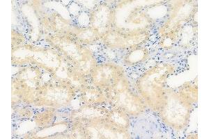 ABIN6264994 and ABIN6279792 at 1/100 staining human renal cell carcinoma by IHC-P. (Septin 5 Antikörper  (Internal Region))