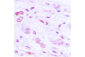 Immunohistochemical analysis of ATF2 (pS112) staining in human lung cancer formalin fixed paraffin embedded tissue section. (ATF2 Antikörper  (pSer112))