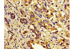 Immunohistochemistry of paraffin-embedded human liver cancer using ABIN7148357 at dilution of 1:100 (C1S Antikörper  (AA 519-688))