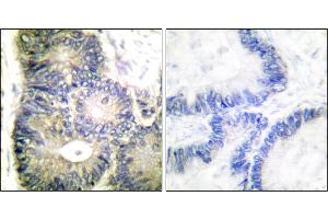 Immunohistochemical analysis of paraffin-embedded human colon carcinoma tissue using Cytochrome c antibody. (Cytochrome C Antikörper)