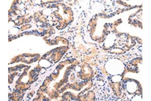 The image on the left is immunohistochemistry of paraffin-embedded Human thyroid cancer tissue using ABIN7191260(Lambda Light chain Antibody) at dilution 1/20, on the right is treated with synthetic peptide. (IGLV1-51 Antikörper)