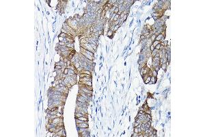 Immunohistochemistry of paraffin-embedded human colon carcinoma using  antibody (ABIN6127437, ABIN6136922, ABIN6136923 and ABIN6217829) at dilution of 1:50 (40x lens). (Annexin A13 Antikörper  (AA 1-316))