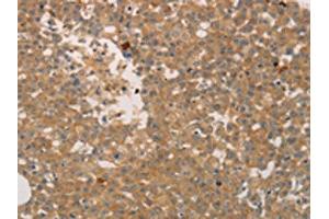 The image on the left is immunohistochemistry of paraffin-embedded Human breast cancer tissue using ABIN7189672(ADCYAP1R1 Antibody) at dilution 1/70, on the right is treated with synthetic peptide. (ADCYAP1R1 Antikörper)