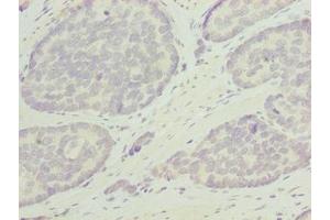 Immunohistochemistry of paraffin-embedded human gastric cancer using ABIN7162346 at dilution of 1:100 (ODF3L1 Antikörper  (AA 1-274))