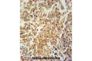TEX9 antibody (N-term) immunohistochemistry analysis in formalin fixed and paraffin embedded human testis carcinoma followed by peroxidase conjugation of the secondary antibody and DAB staining. (TEX9 Antikörper  (N-Term))