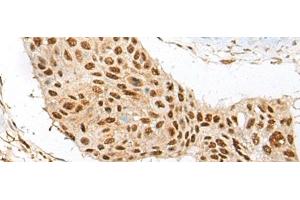 Immunohistochemistry of paraffin-embedded Human esophagus cancer tissue using ATE1 Polyclonal Antibody at dilution of 1:60(x200) (ATE1 Antikörper)