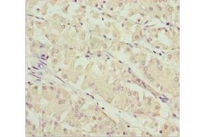 Immunohistochemistry of paraffin-embedded human gastric cancer using ABIN7171004 at dilution of 1:100 (SOCS4 Antikörper  (AA 1-270))
