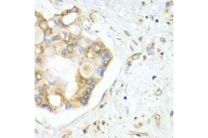 Immunohistochemistry of paraffin-embedded human liver cancer using VTI1B antibody (ABIN5974248) at dilution of 1/100 (40x lens).
